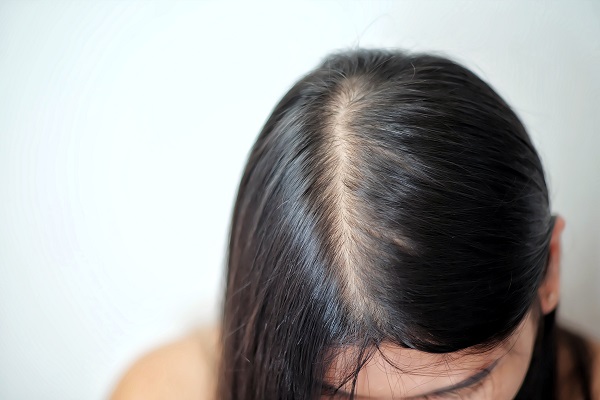 Popular Female Pattern Baldness Treatment Dillon Hair Restoration In