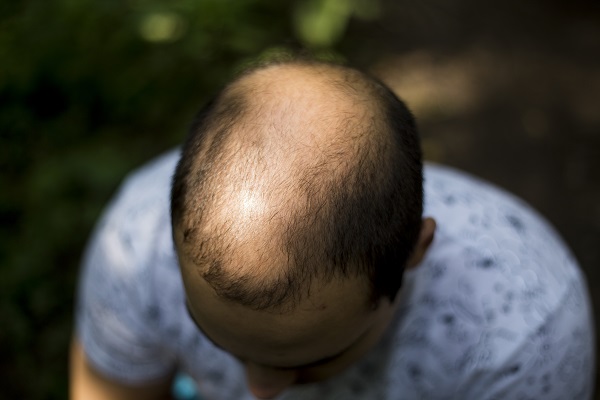 Commonly Asked Questions About Androgenic Alopecia Treatment