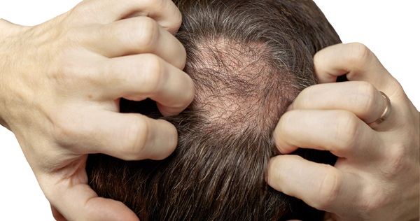 Reasons To Consider A Hair Graft